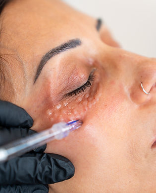 Mesoterapia con vitaminas (NCTF)