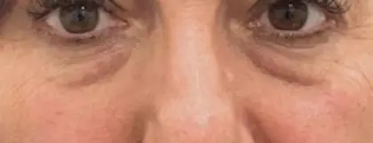 tratamento para infeção nos lábios após preenchimento labial