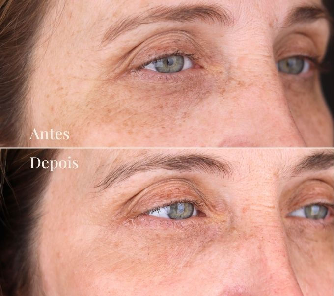 Antes e Depois: Tratamento com laser BBL HEROic