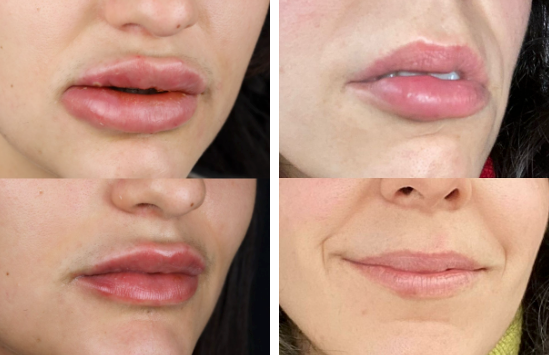 Como o Endolift atua para solucionar complicações por preenchimentos com ácido hialurónico?