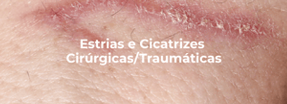 Tratamento de Estrias e Cicatrizes CirúrgicasTraumáticas - Estrias e Cicatrizes - Clínica