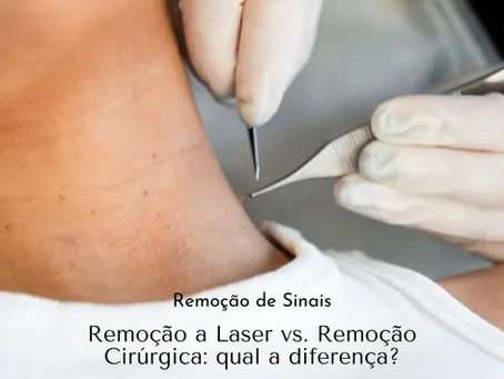 Remoção de sinais a laser vs. remoção cirúrgica: qual a diferença?