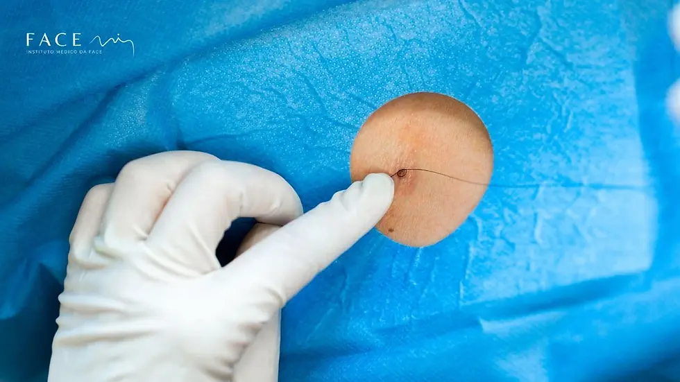 Remoção de sinais a laser vs. remoção cirúrgica: qual a diferença?