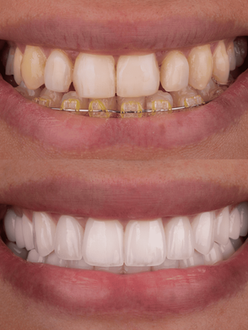 ceramic veneers
