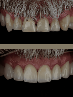 Dental Bridge and crowns