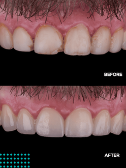 ceramic veneers