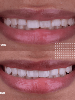 ceramic veneers