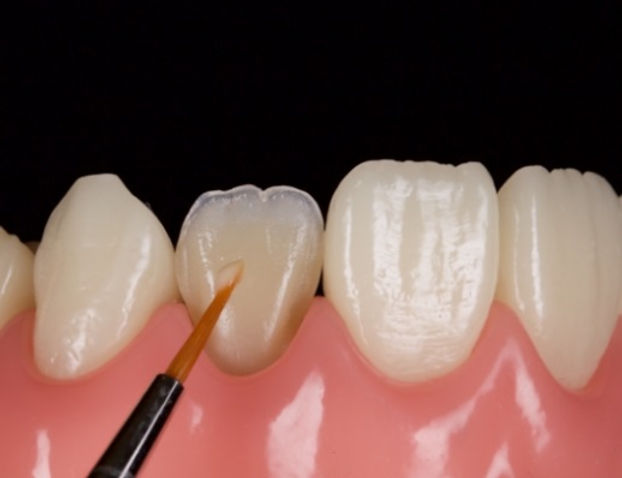 Composite-Resin-Veneers