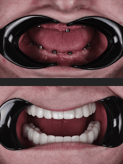 full jaw dental implants