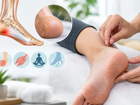 How Acupuncture Treats Plantar Fasciitis Pain