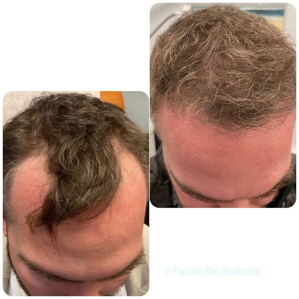 Hair loss restoration