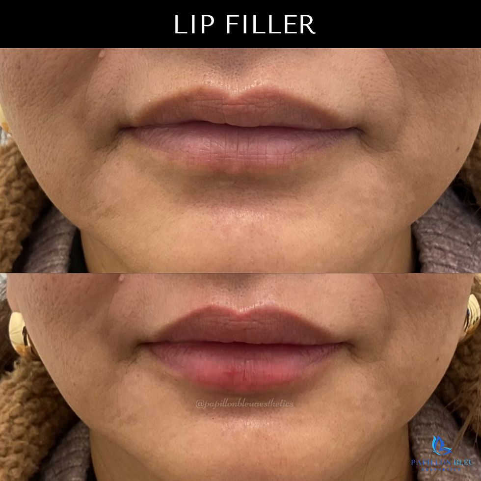 LIP FILLER (2)