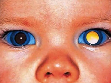 RETINOBLASTOMA... un reflejo