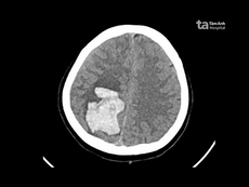 AI robot performs surgery to save pregnant woman who had a stroke due to preeclampsia