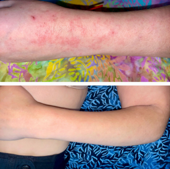 Treating Skin Conditions with Chinese Medicine