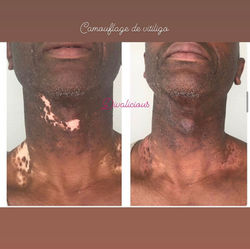 Camouflage vitiligo