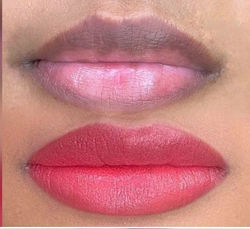 Neutralisation de lèvres hyperpigmentées