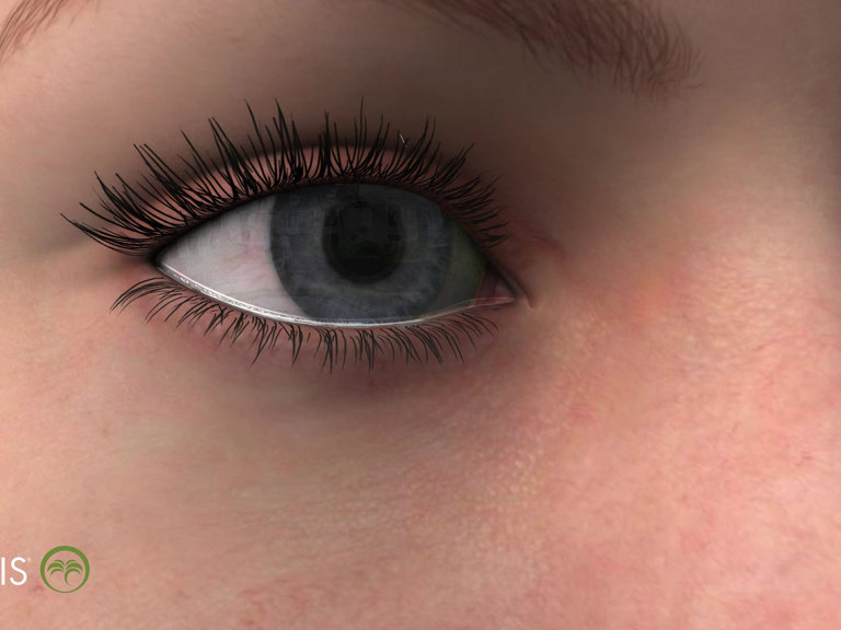 Punctal Plugs A Guide to Understanding and Treating Dry Eye Syndrome