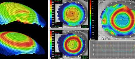 Ortho-K or CRT Lenses and Myopia Control: How does it work?