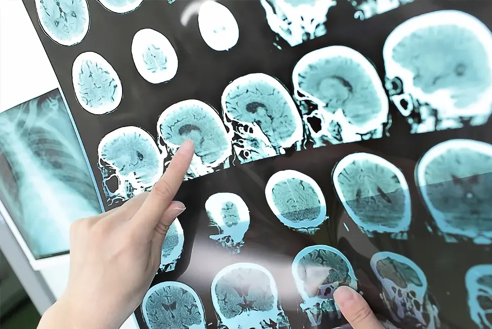 How a Visit to Your Dentist Could Help Reduce Alzheimer's Risk