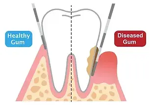 Gum-probing_ORAL HYGIENE Ajax & Scarborough Favourite Dental Office and Dentist.webp