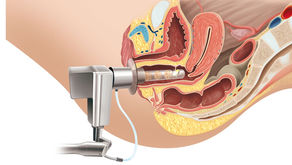 Menopausa: Laser vaginal trata secura, incontinência e melhora vida sexual