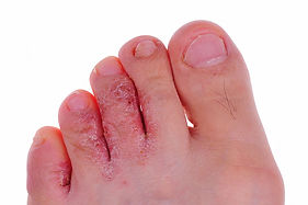 Athletes-foot.jpeg
