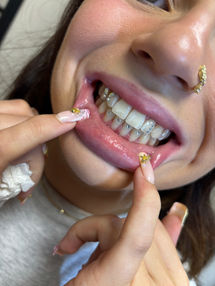 strass dentaire 77 Lagny-sur-Marne sur marne 