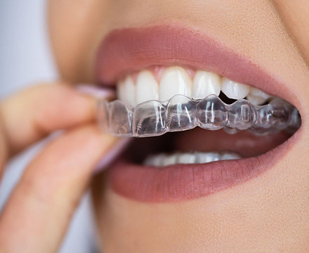 invisalign genova
