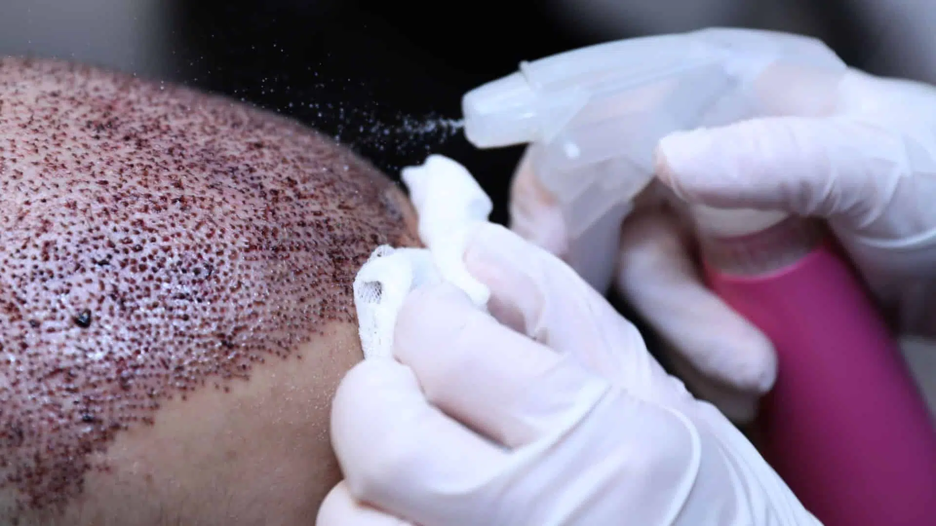 A man getting his hair transplant cleaned by medical staff
