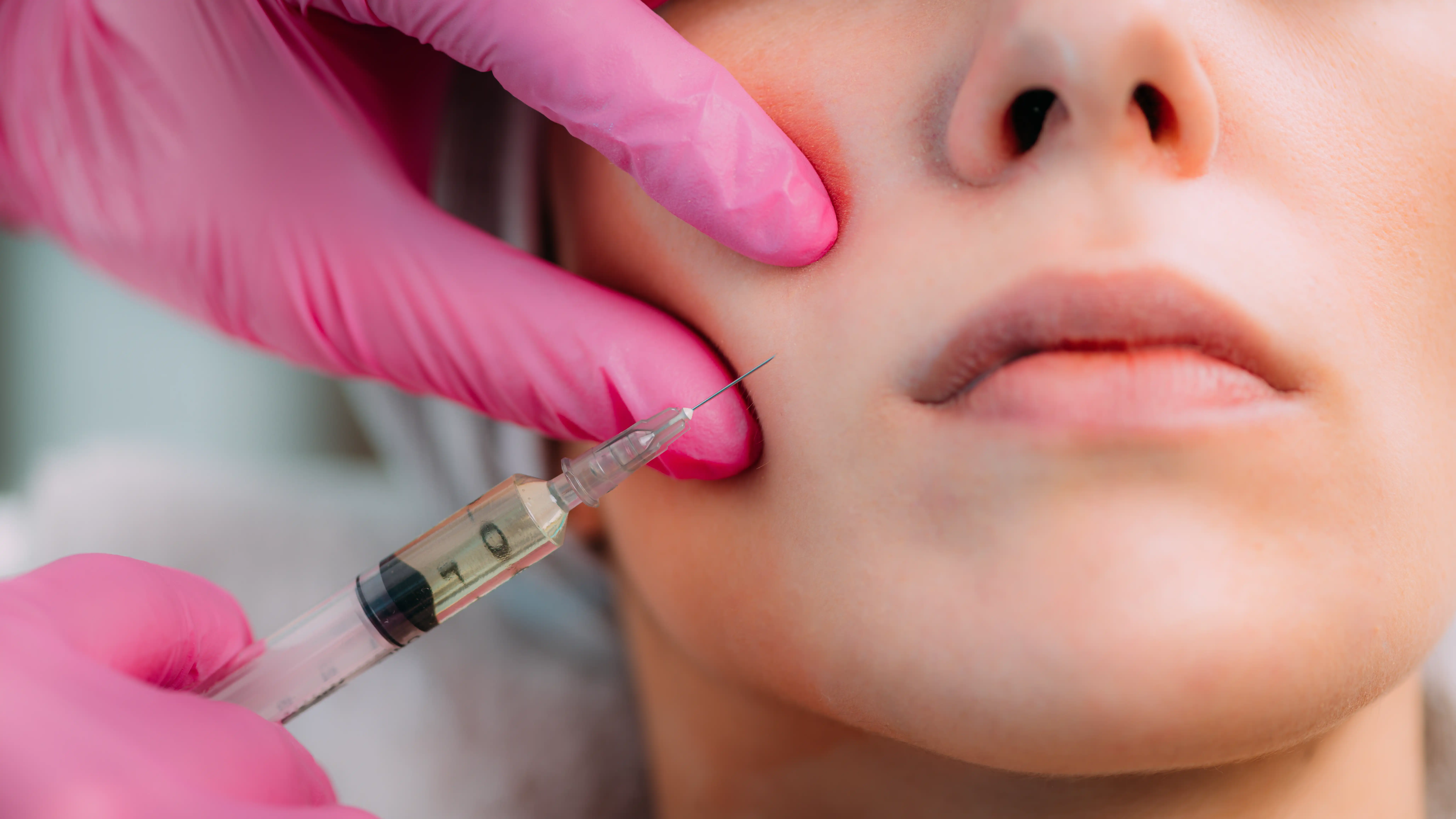 dermal-filler-injection-for-cheeks