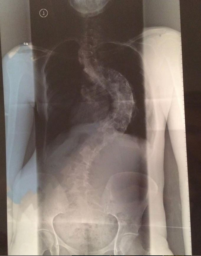 x ray of spine showing severe S curve scoliosis