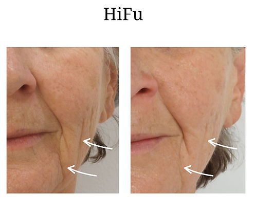 hifu resultaat