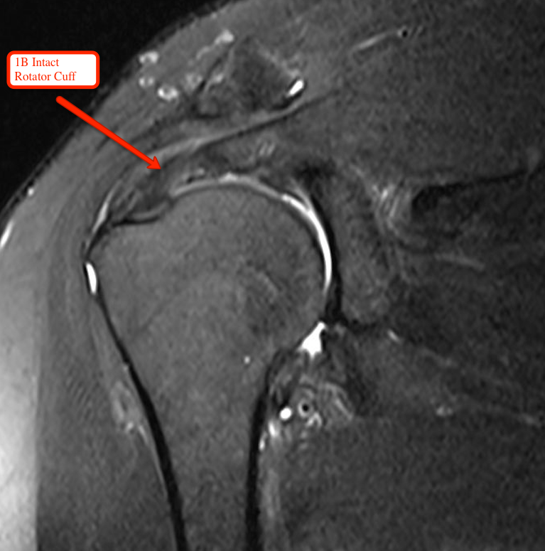 MRI of the Shoulder Showing a Normal Intact Rotator Cuff