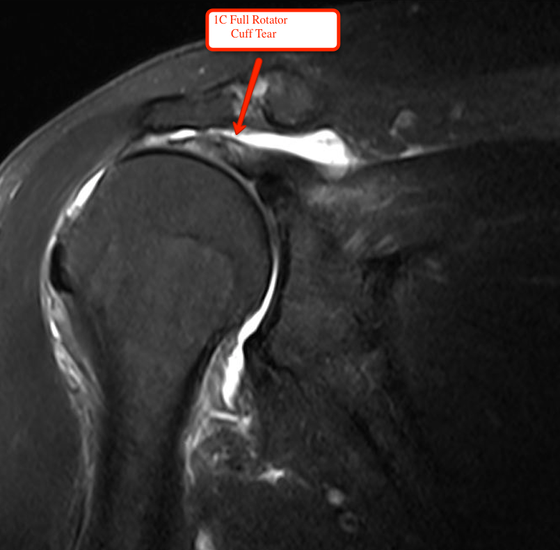 MRI of the Shoulder Showing a Full Rotator Cuff Tear