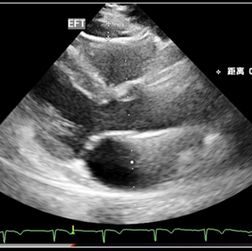 Relationship between epicardial fat tissue, endothelial function, and coronary flow reserve in coronary microvascular disease patients