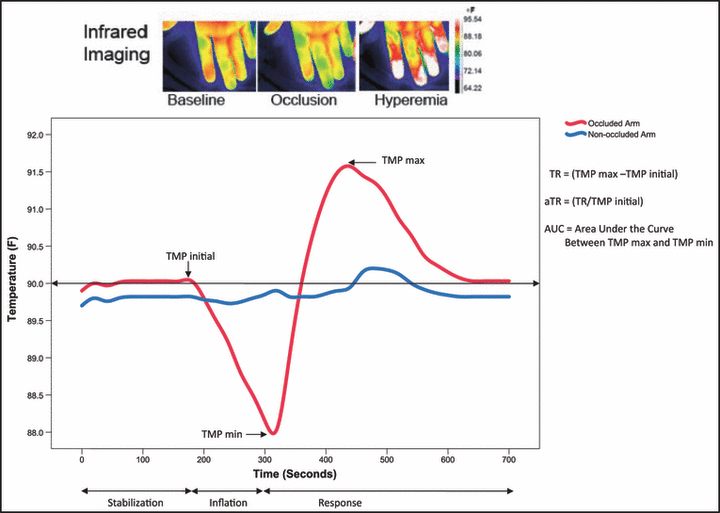 Vascular function measured by fingertip thermal reactivity is impaired in patients with metabolic...