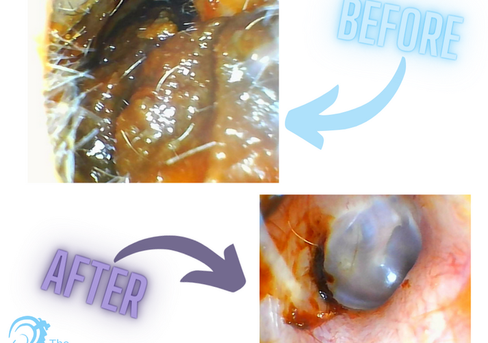 Microsuction Earwax Eemoval