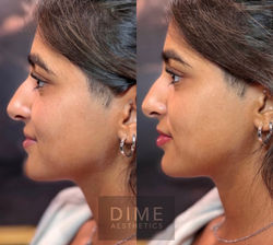 Lip Filler