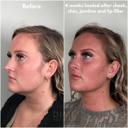 Facial Balancing Filler