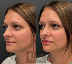 Lip Filler (2)