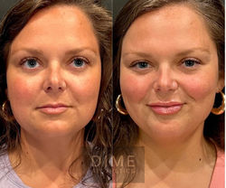 Lip filler