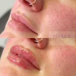Lip Filler