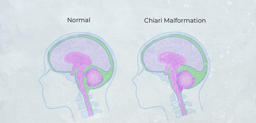 Unlocking the Mysteries of Chiari Malformation: A Comprehensive Guide