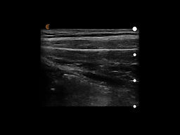 Transversus abdominus muscle contracted