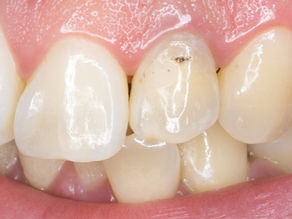 Blanqueamiento interno: ¿qué hacer cuando un diente se pone oscuro? | Novo Dental