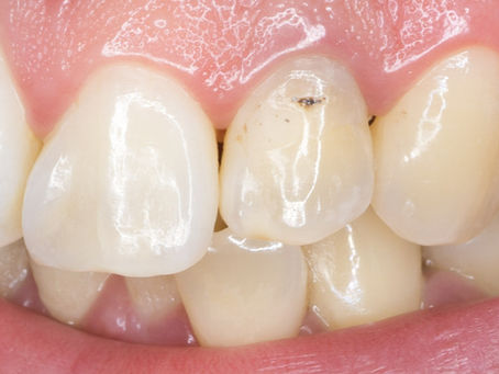 Blanqueamiento interno: ¿qué hacer cuando un diente se pone oscuro? | Novo Dental