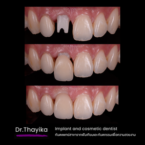 drthayika implants2.png