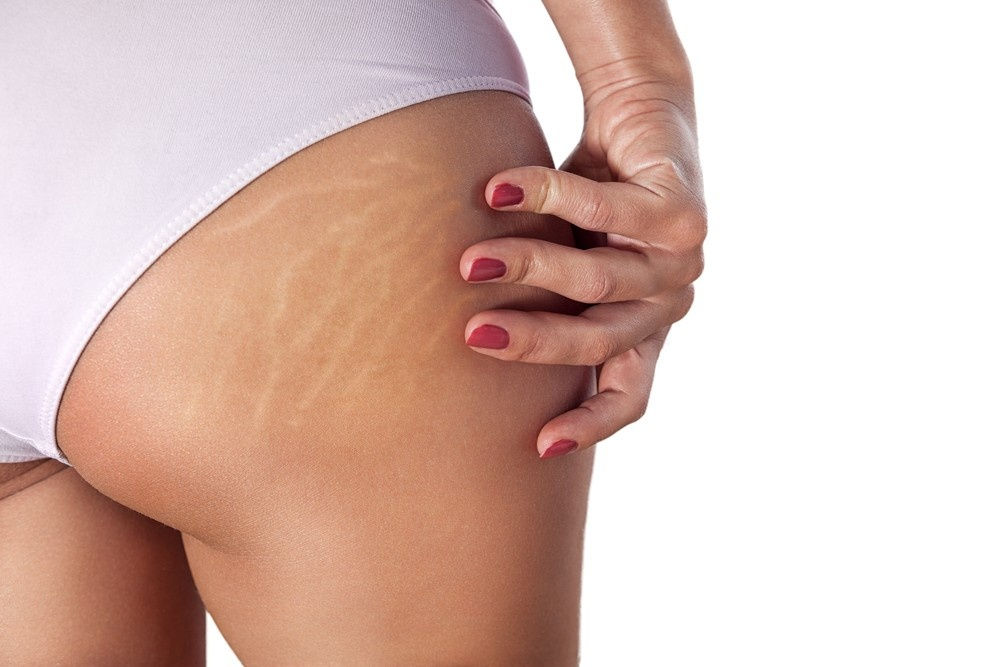 NOdztlkGQsKcSX5x3m56_Inkless_Stretch_Mark_RevisionBBC_.jpg