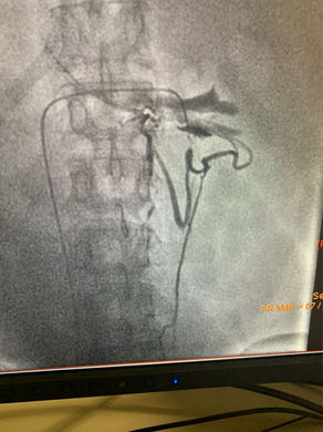 Embolisation Varicocèle